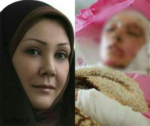 ماجرای اسیدپاشی روی صورت رویا دیباوند کاندیدای شورای اسلامی شهر ارومیه